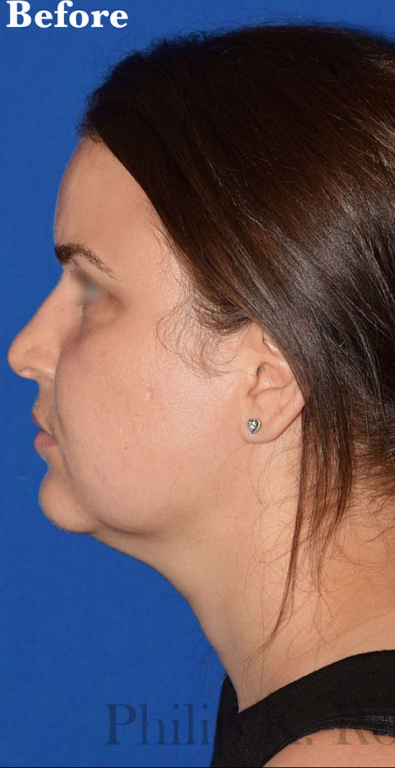 Buccal Fat Reduction Before & After Gallery - Patient 113775 - Image 5