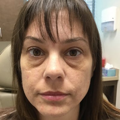 Fillers Before & After Gallery - Patient 172027 - Image 1