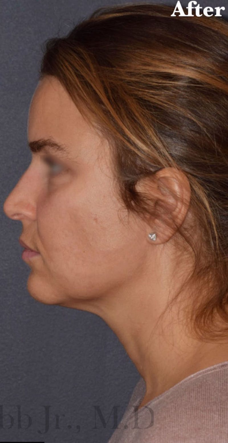 Buccal Fat Reduction Before & After Gallery - Patient 113775 - Image 6