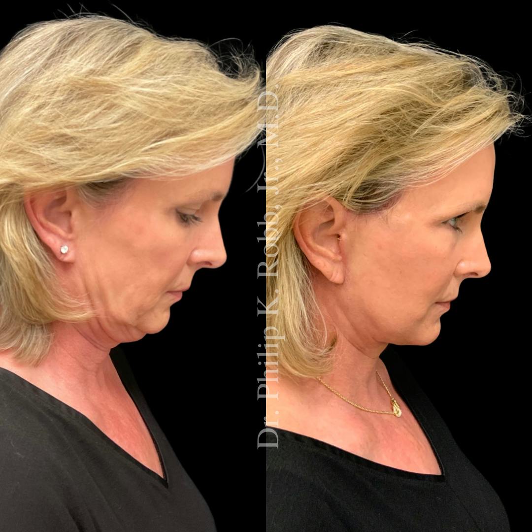 Brow Lift Before & After Gallery - Patient 267630 - Image 7
