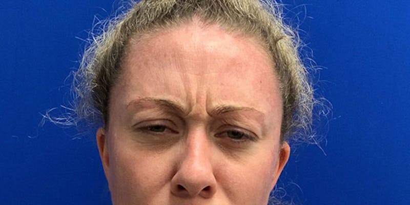 Botox & Dysport Before & After Gallery - Patient 127589 - Image 3