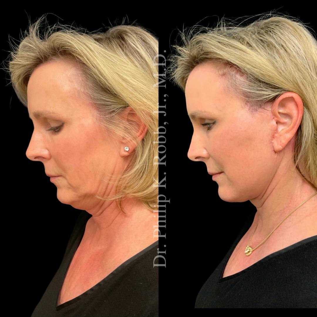 Brow Lift Before & After Gallery - Patient 267630 - Image 4