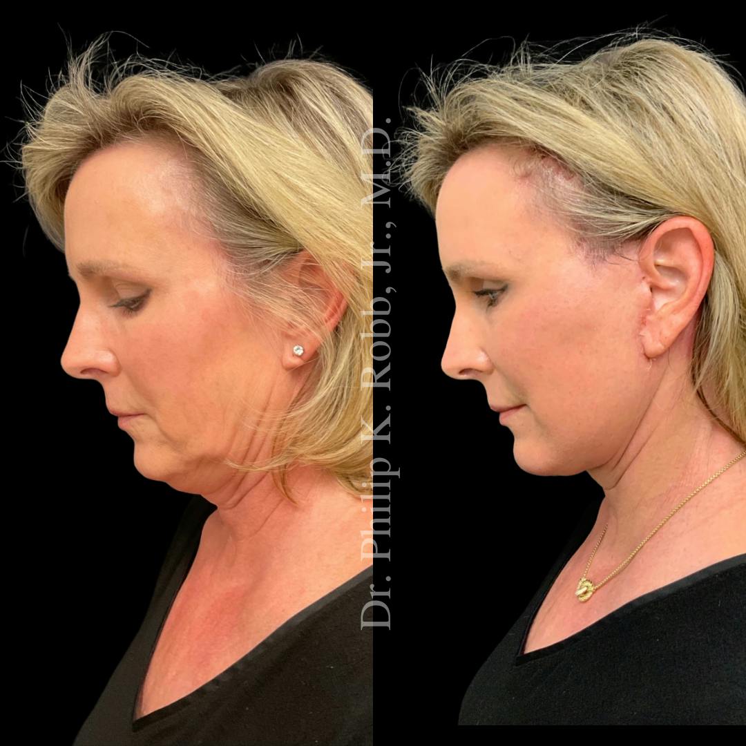 Brow Lift Before & After Gallery - Patient 267630 - Image 5