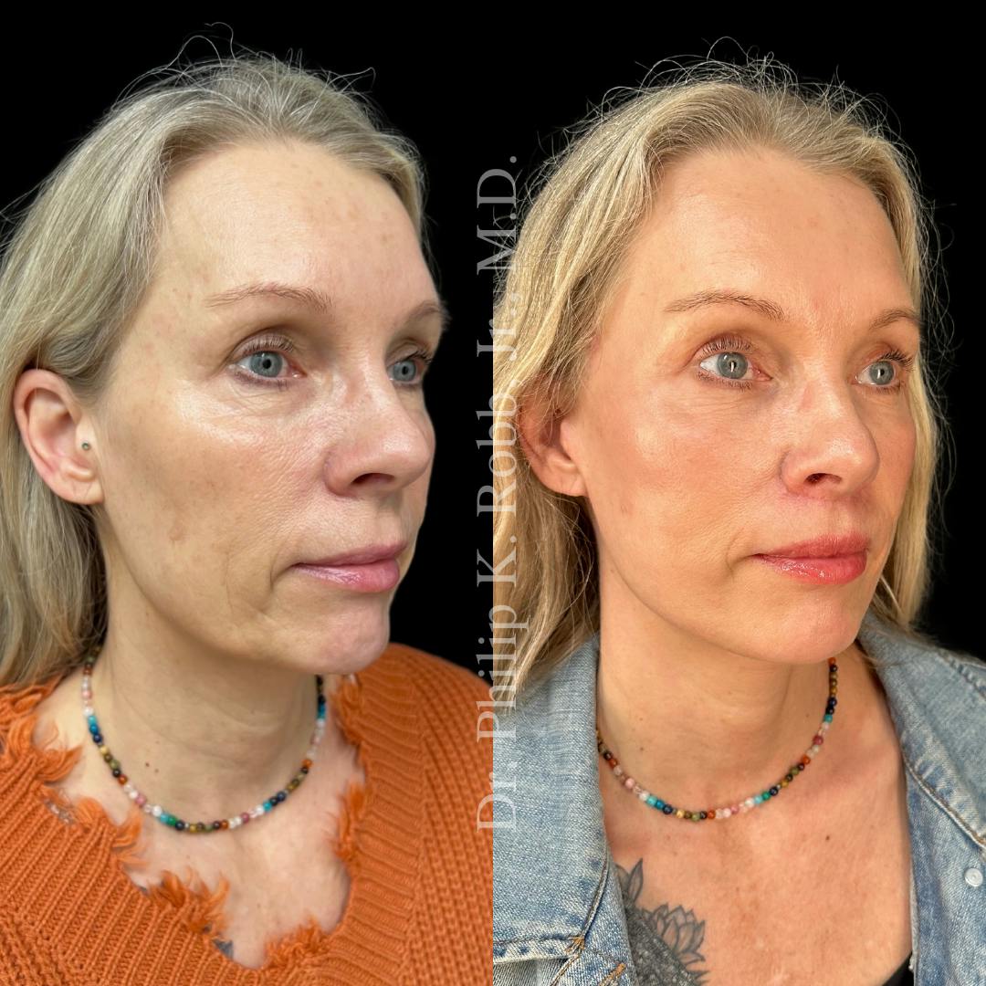 Lip Lift Before & After Gallery - Patient 429248 - Image 2