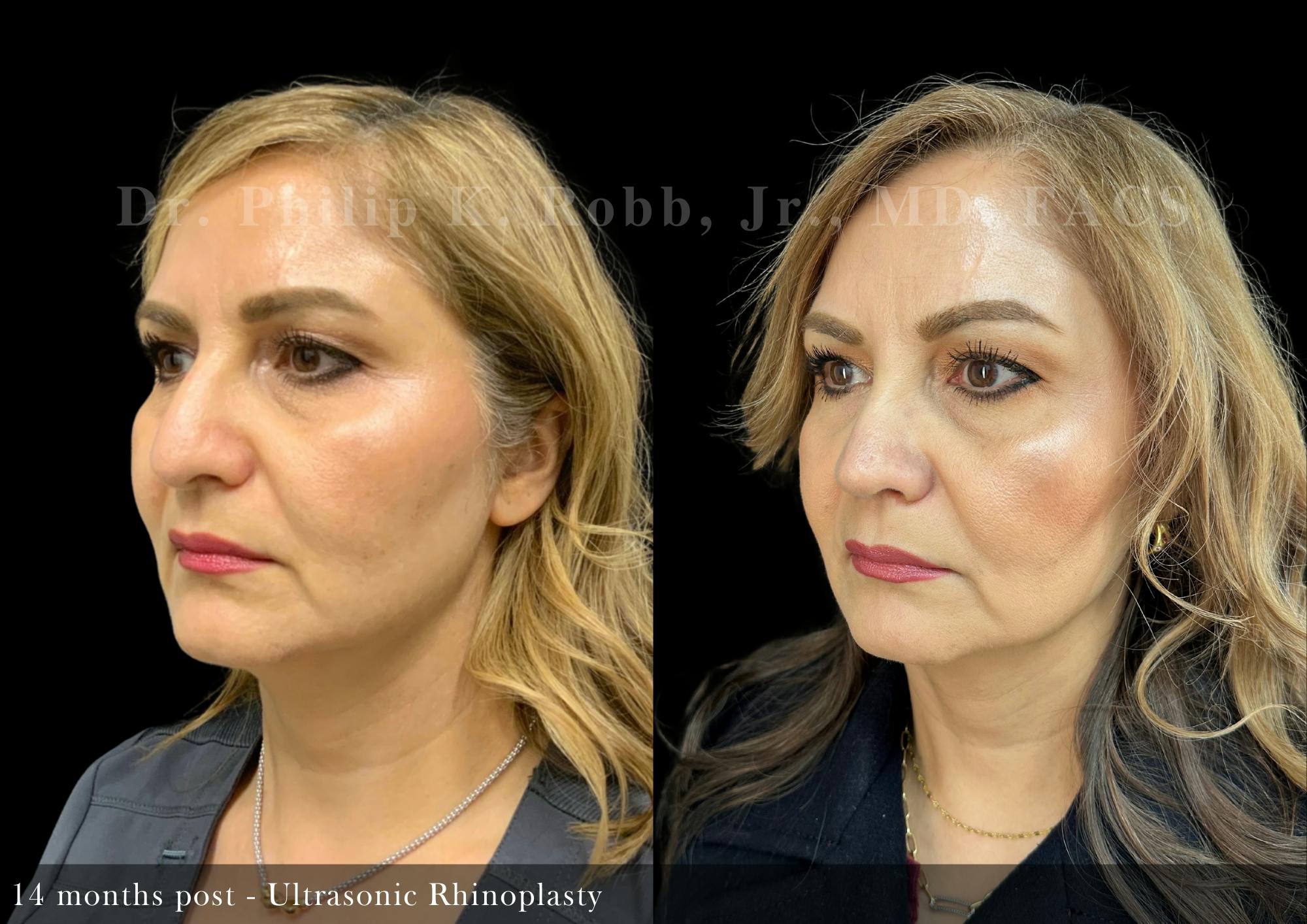 Ultrasonic Rhinoplasty Before & After Gallery - Patient 227153 - Image 5