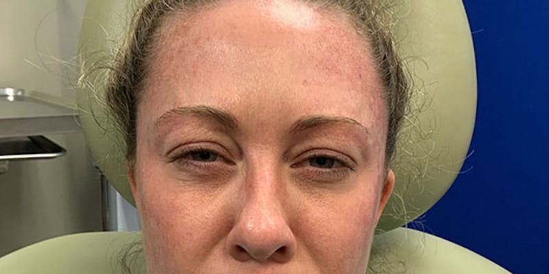 Botox & Dysport Before & After Gallery - Patient 127589 - Image 4