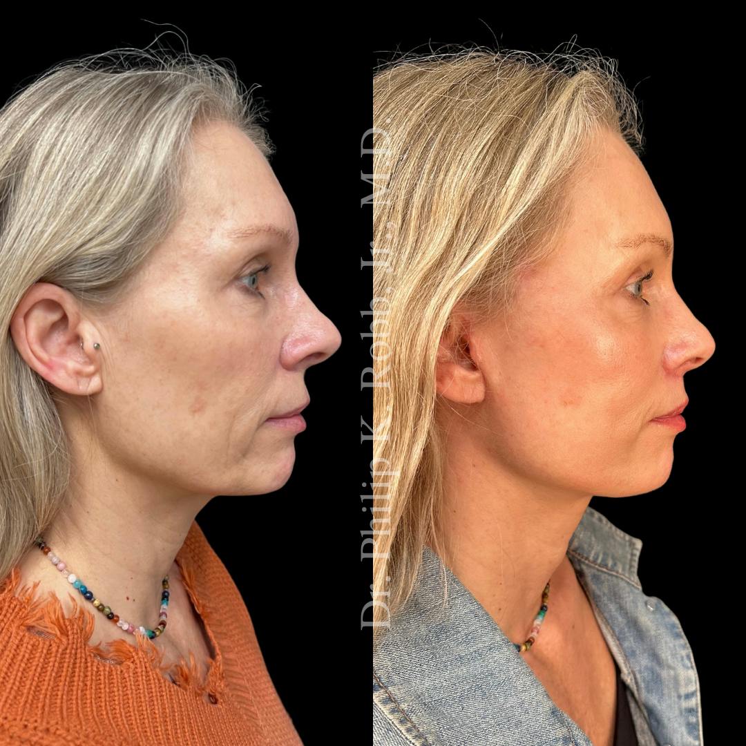 Lip Lift Before & After Gallery - Patient 429248 - Image 3