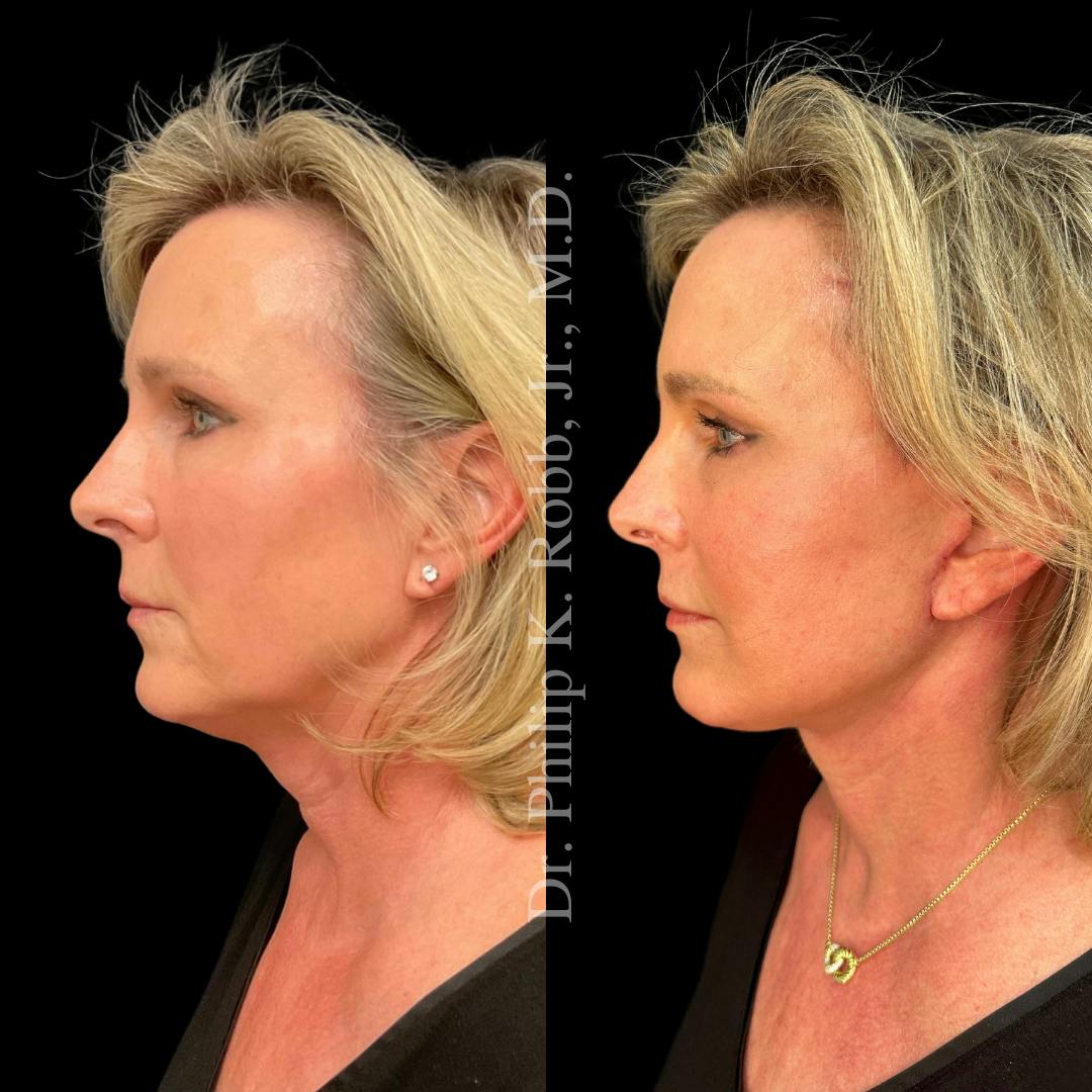 Brow Lift Before & After Gallery - Patient 267630 - Image 3