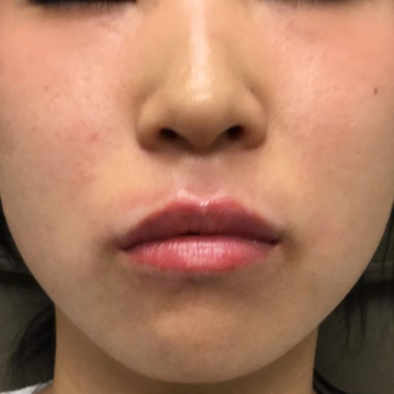Fillers Before & After Gallery - Patient 423612 - Image 2