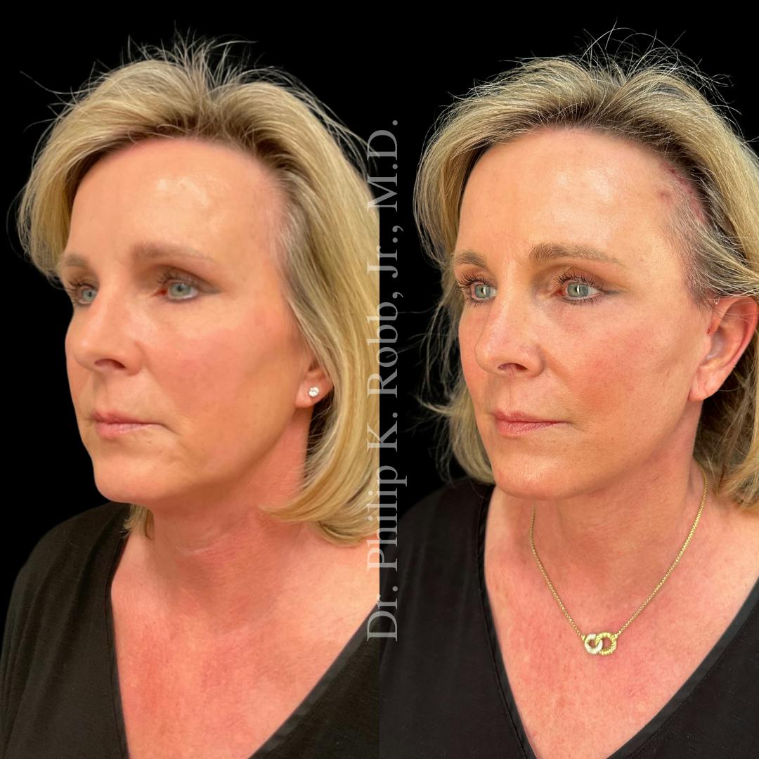 Brow Lift Before & After Gallery - Patient 267630 - Image 7