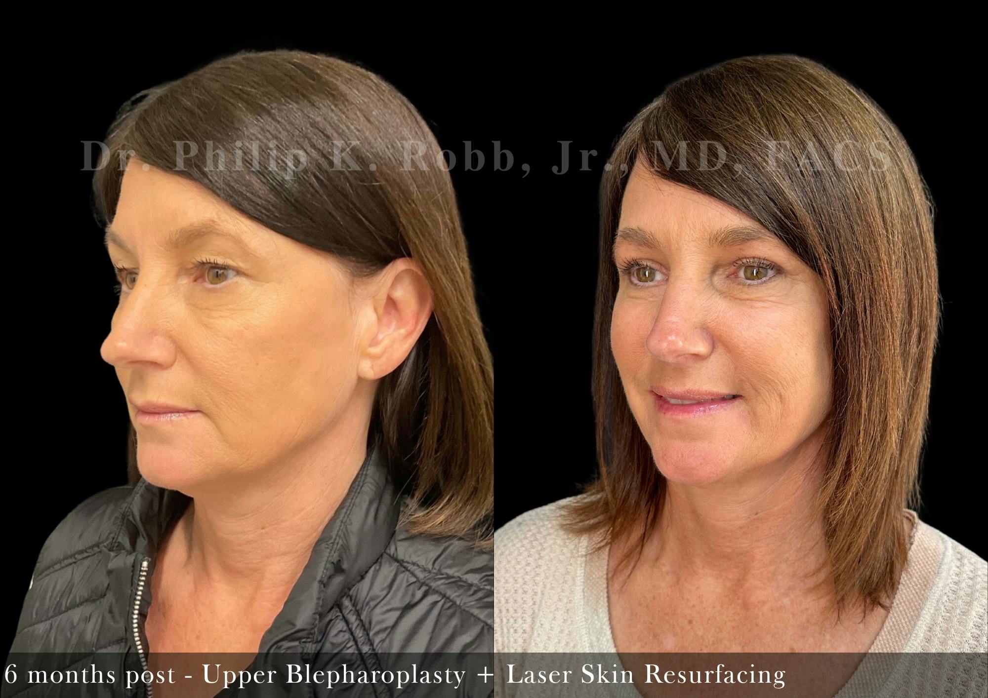 Upper Blepharoplasty Before & After Gallery - Patient 252900 - Image 2