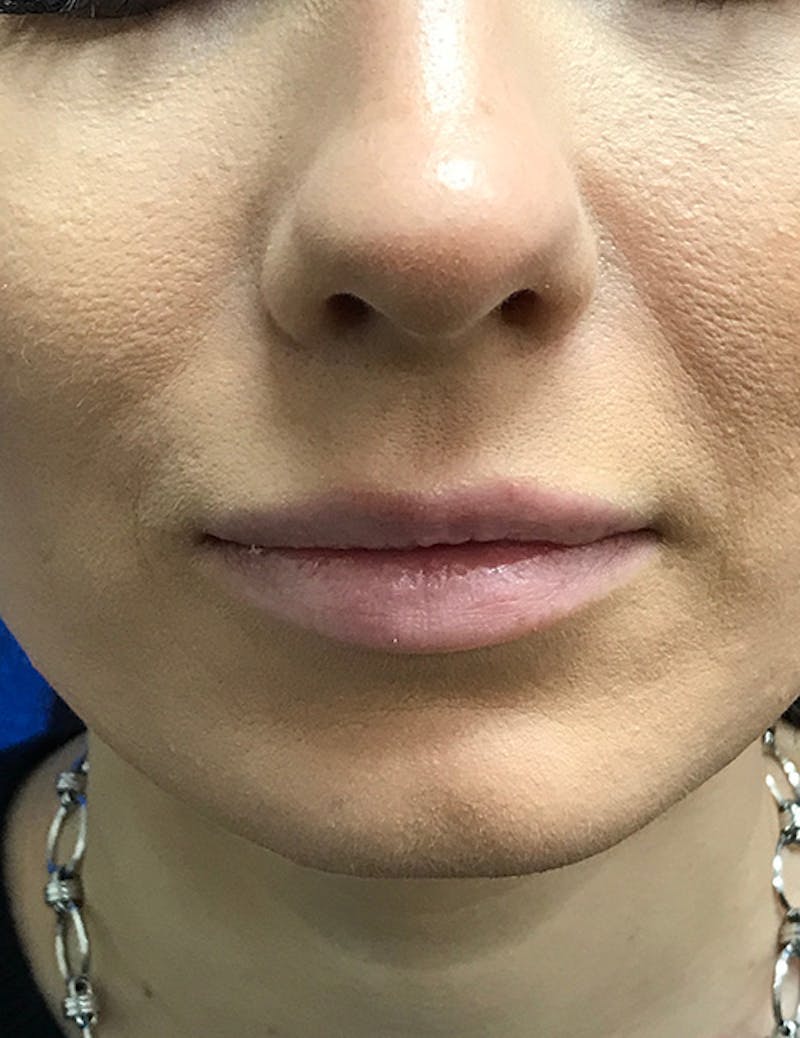 Fillers Before & After Gallery - Patient 183984 - Image 1