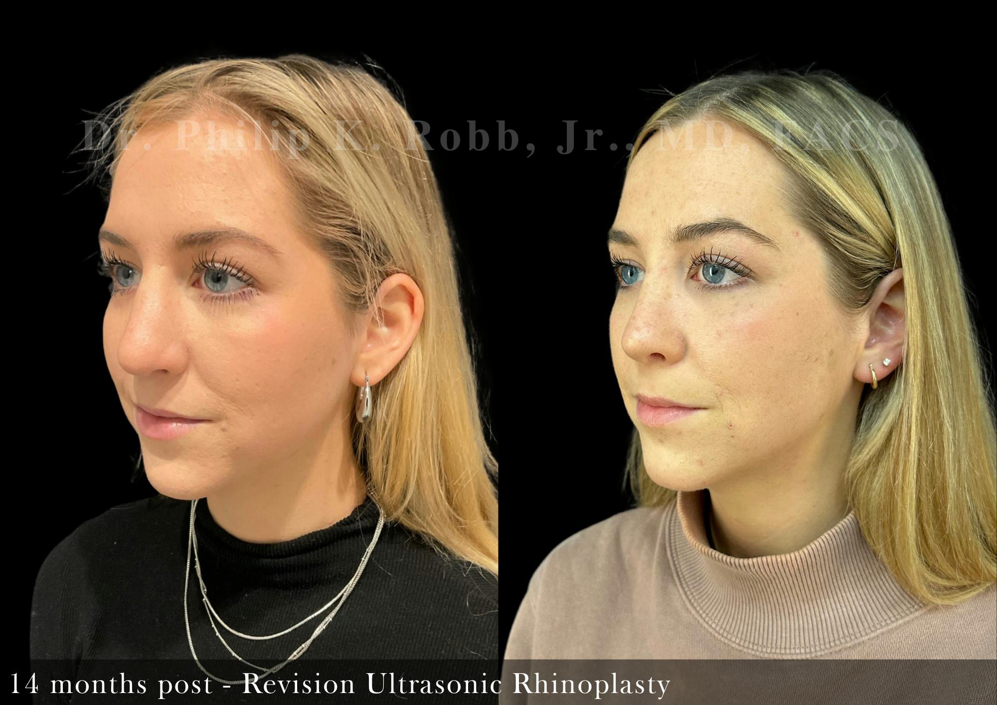 Revision Ultrasonic Rhinoplasty Before & After Gallery - Patient 163101 - Image 5