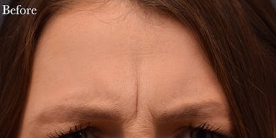 Botox & Dysport Before & After Gallery - Patient 728577 - Image 1