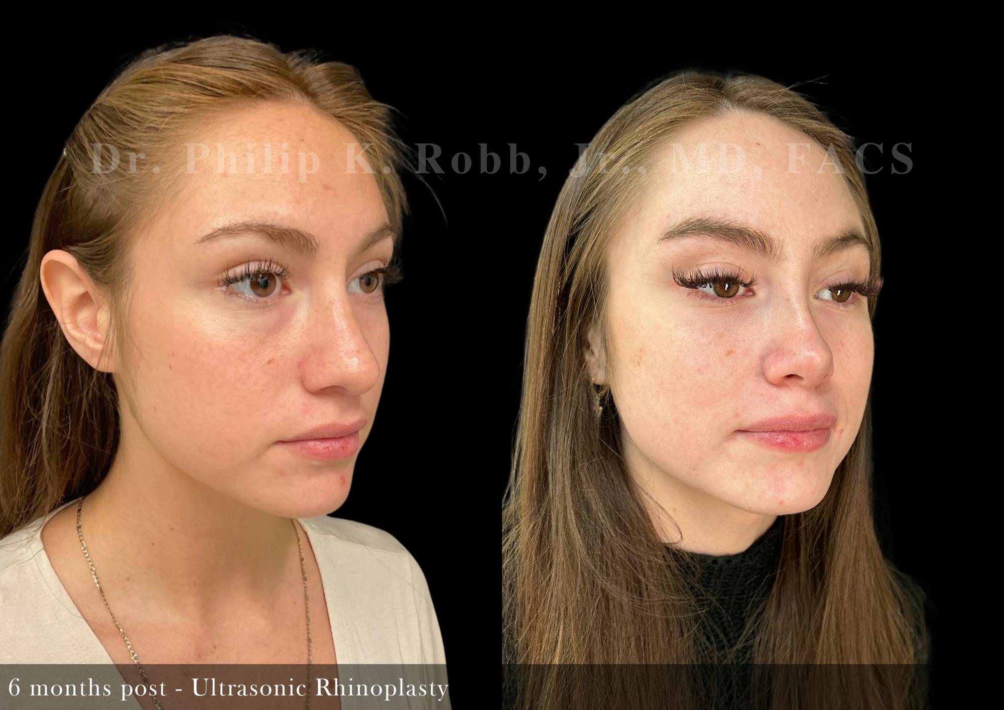 Ultrasonic Rhinoplasty Before & After Gallery - Patient 324664 - Image 2