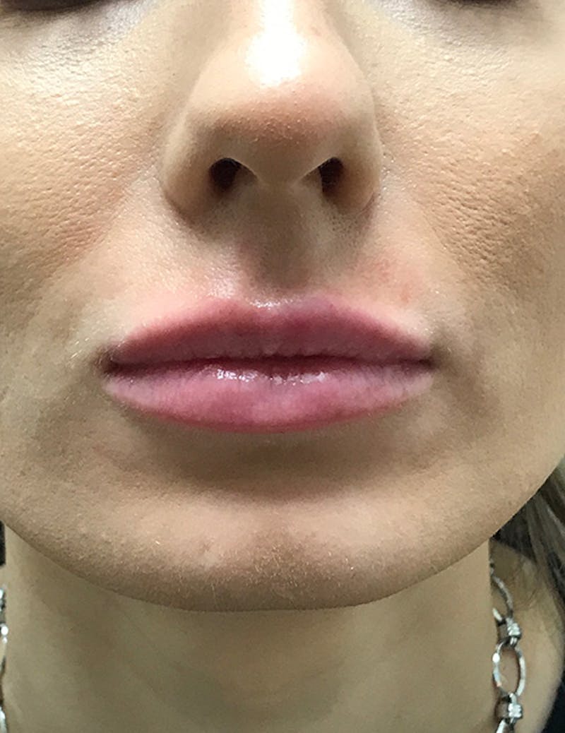 Fillers Before & After Gallery - Patient 183984 - Image 2