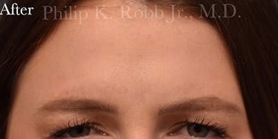 Botox & Dysport Before & After Gallery - Patient 728577 - Image 2