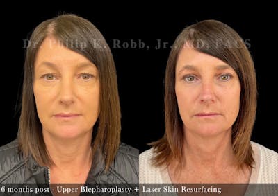 Upper Blepharoplasty Before & After Gallery - Patient 252900 - Image 1