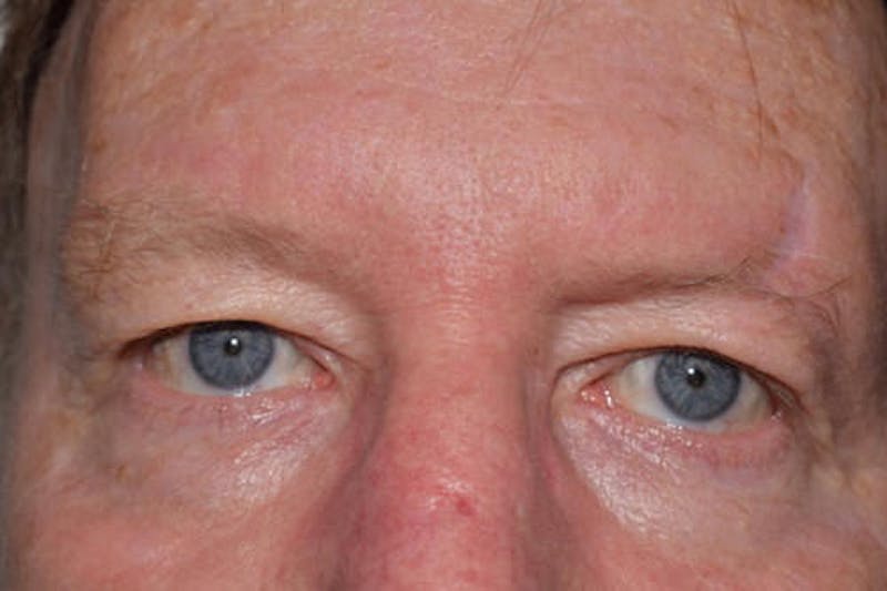 Brow Lift Before & After Gallery - Patient 298092 - Image 1