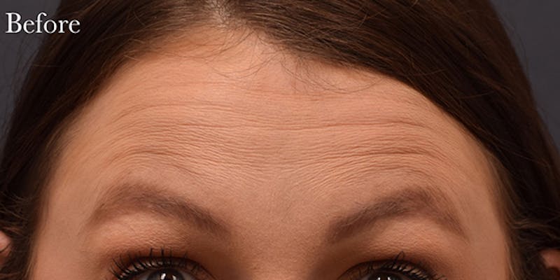 Botox & Dysport Before & After Gallery - Patient 728577 - Image 3