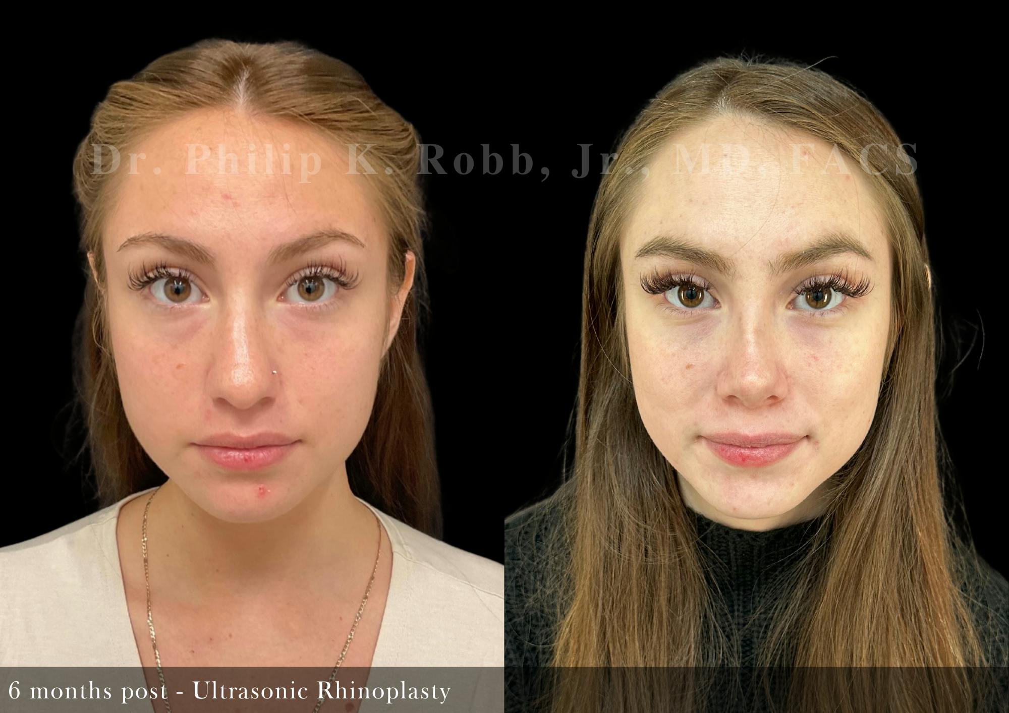 Ultrasonic Rhinoplasty Before & After Gallery - Patient 324664 - Image 3