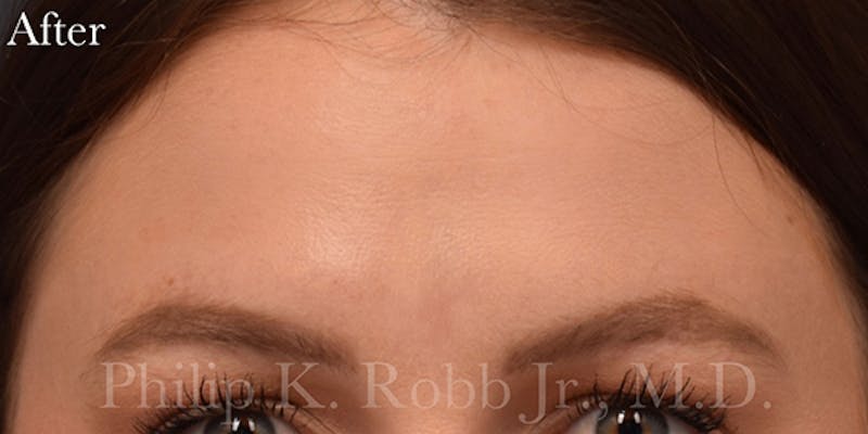 Botox & Dysport Before & After Gallery - Patient 728577 - Image 4