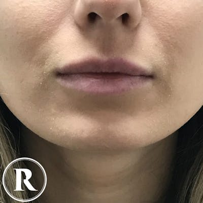 Fillers Before & After Gallery - Patient 396824 - Image 1
