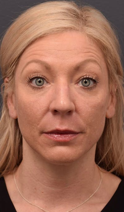 Lip Lift Before & After Gallery - Patient 223006 - Image 1