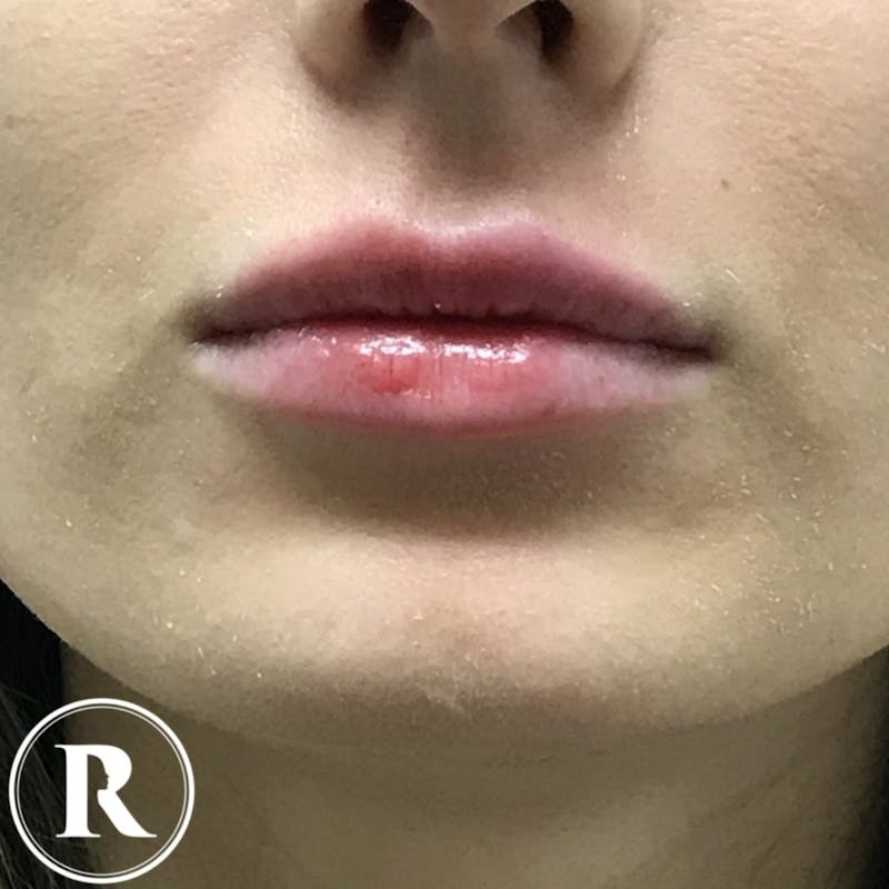 Fillers Before & After Gallery - Patient 396824 - Image 2