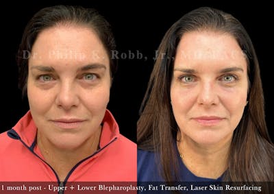 Upper Blepharoplasty Before & After Gallery - Patient 386640 - Image 1