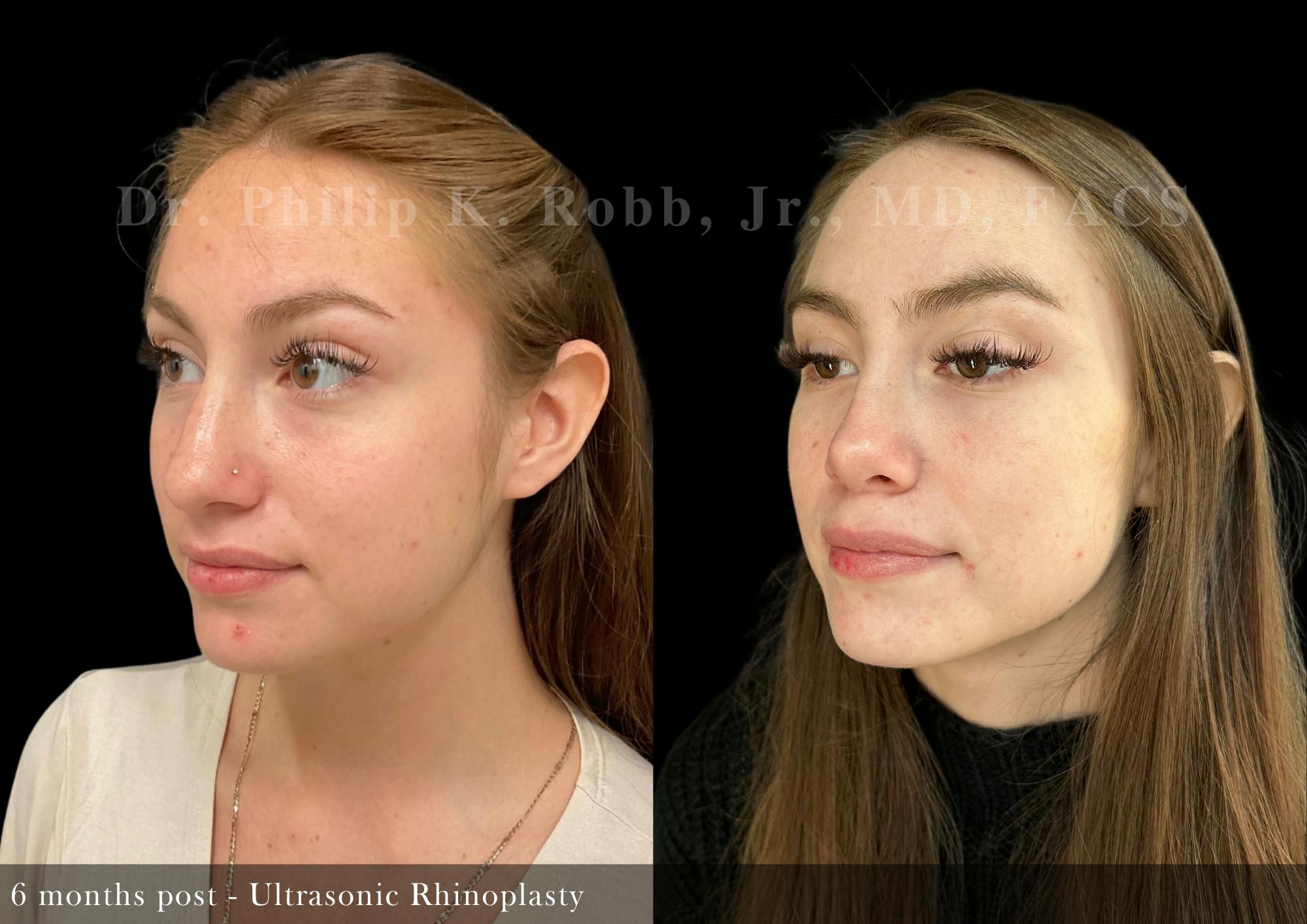 Ultrasonic Rhinoplasty Before & After Gallery - Patient 324664 - Image 5