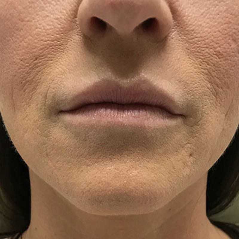 Fillers Before & After Gallery - Patient 250950 - Image 1