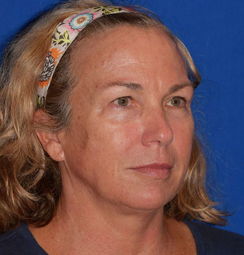 Brow Lift Before & After Gallery - Patient 414707 - Image 4