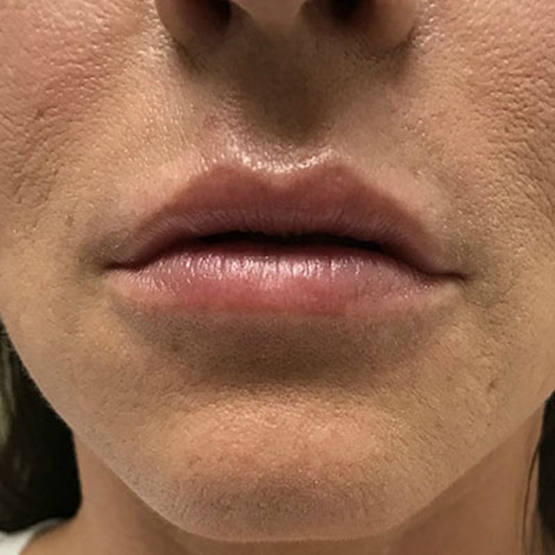 Fillers Before & After Gallery - Patient 250950 - Image 2