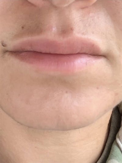Lip Lift Before & After Gallery - Patient 458193 - Image 1