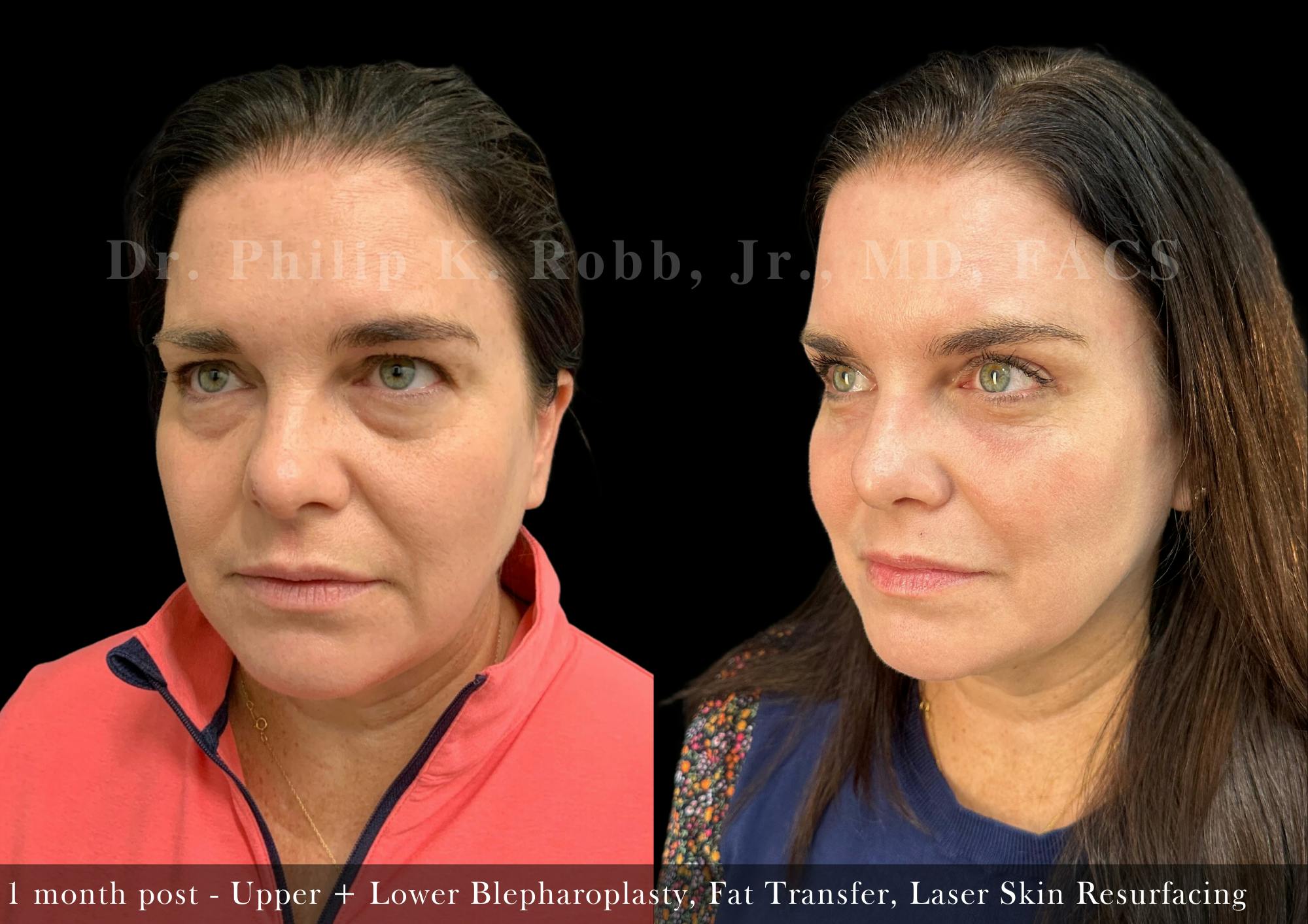 Upper Blepharoplasty Before & After Gallery - Patient 386640 - Image 2