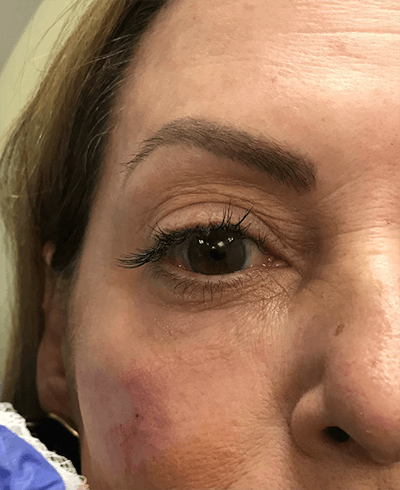 Fillers Before & After Gallery - Patient 407824 - Image 2