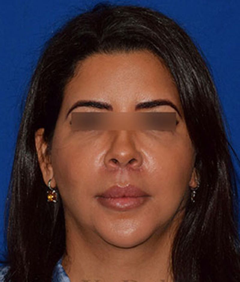 Lip Lift Before & After Gallery - Patient 359219 - Image 2