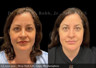 Upper Blepharoplasty Before & After Gallery - Patient 346025 - Image 1