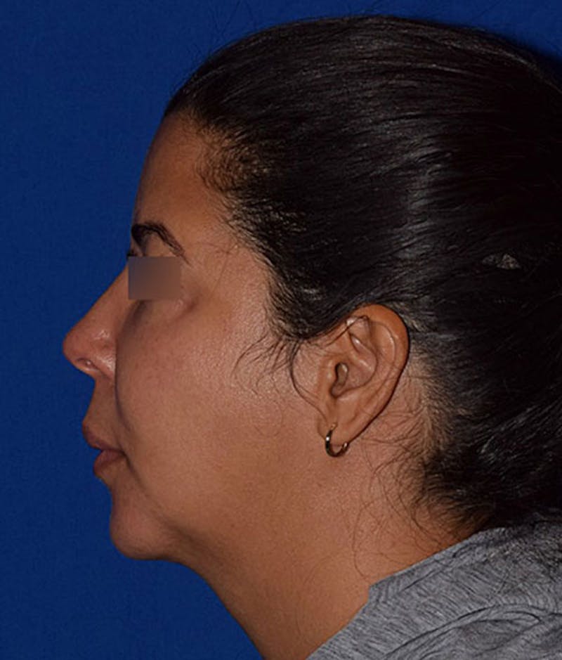 Lip Lift Before & After Gallery - Patient 359219 - Image 5
