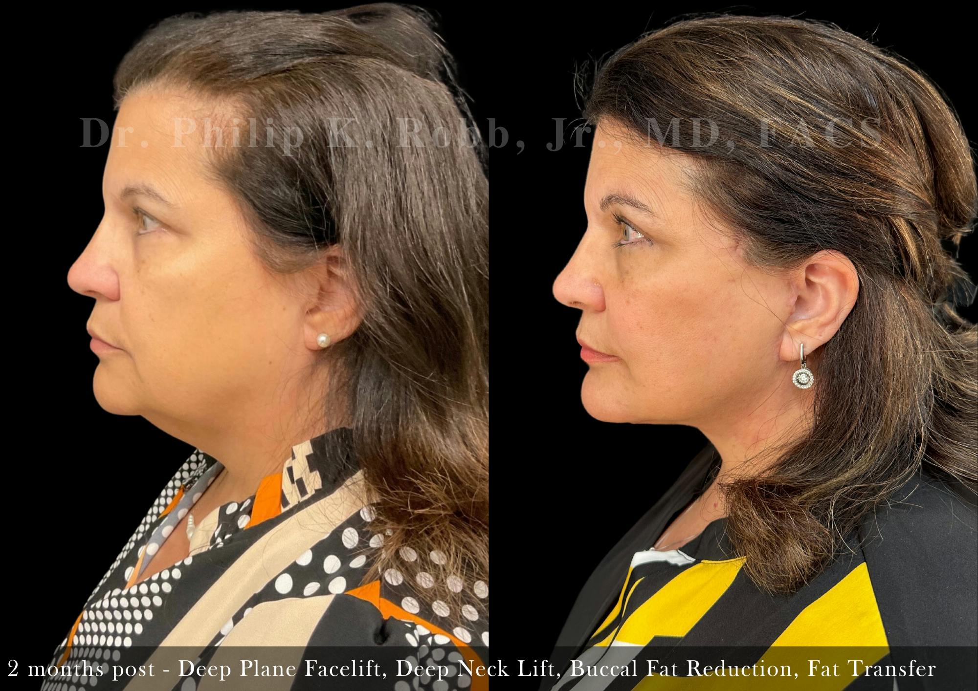 Neck Lift Before & After Gallery - Patient 132070 - Image 1