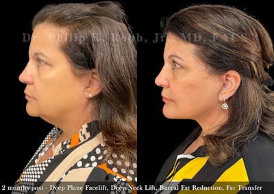 Neck Lift Before & After Gallery - Patient 132070 - Image 1