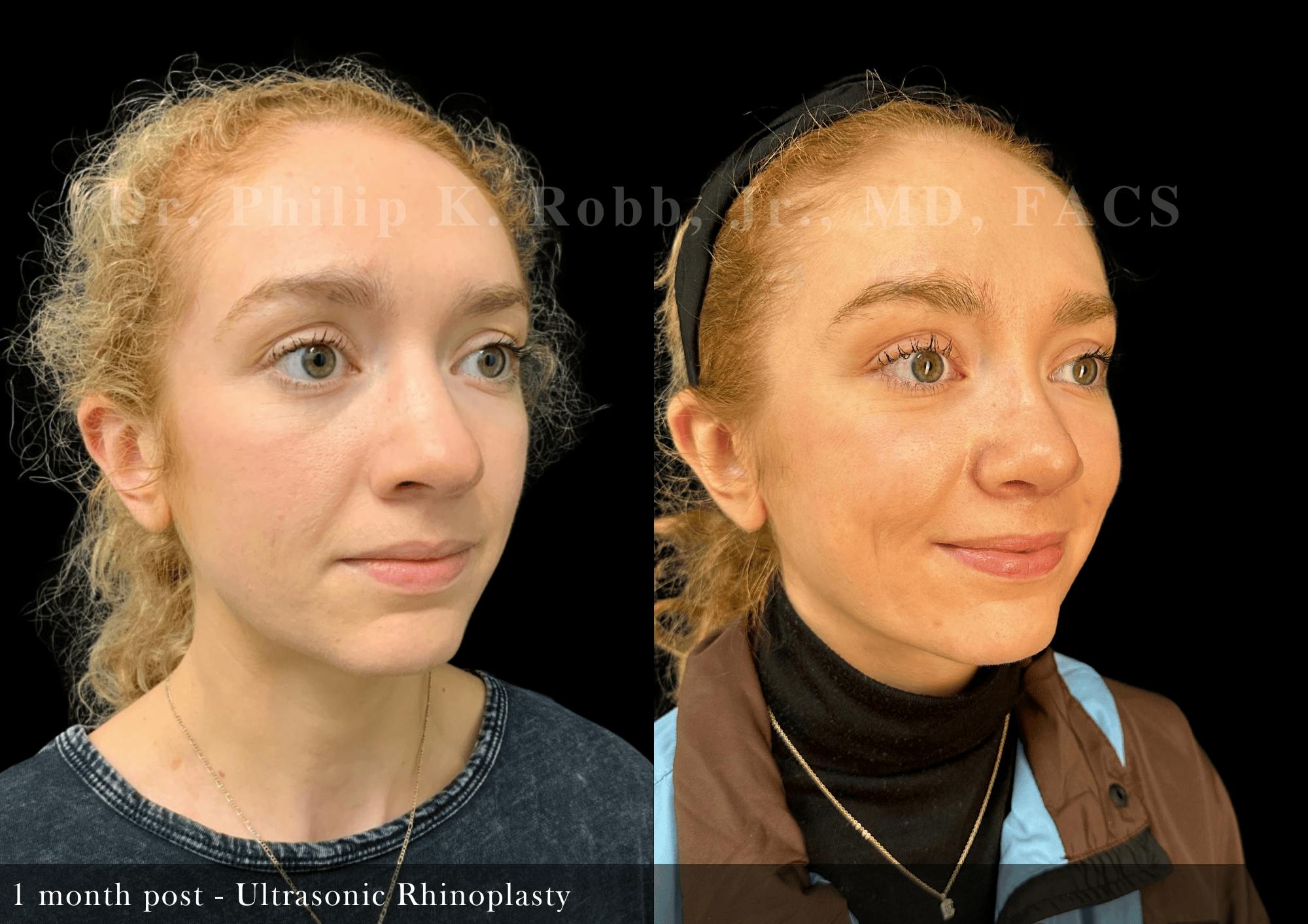 Ultrasonic Rhinoplasty Before & After Gallery - Patient 244260 - Image 2