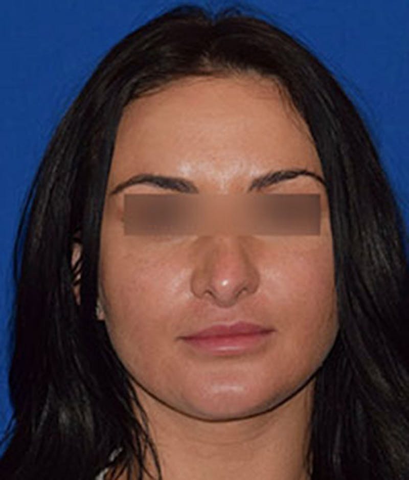 Lip Lift Before & After Gallery - Patient 386914 - Image 2