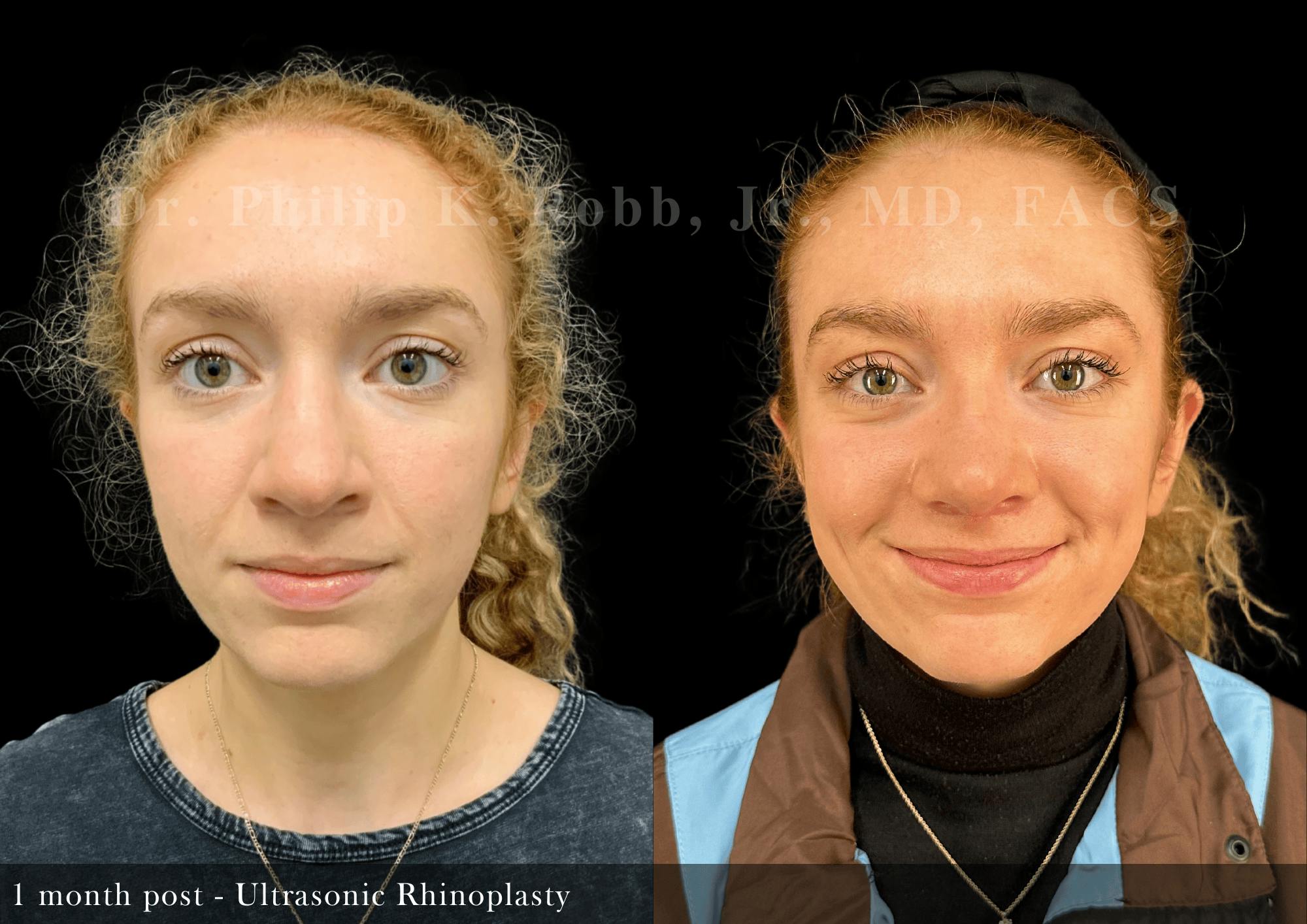 Ultrasonic Rhinoplasty Before & After Gallery - Patient 244260 - Image 3