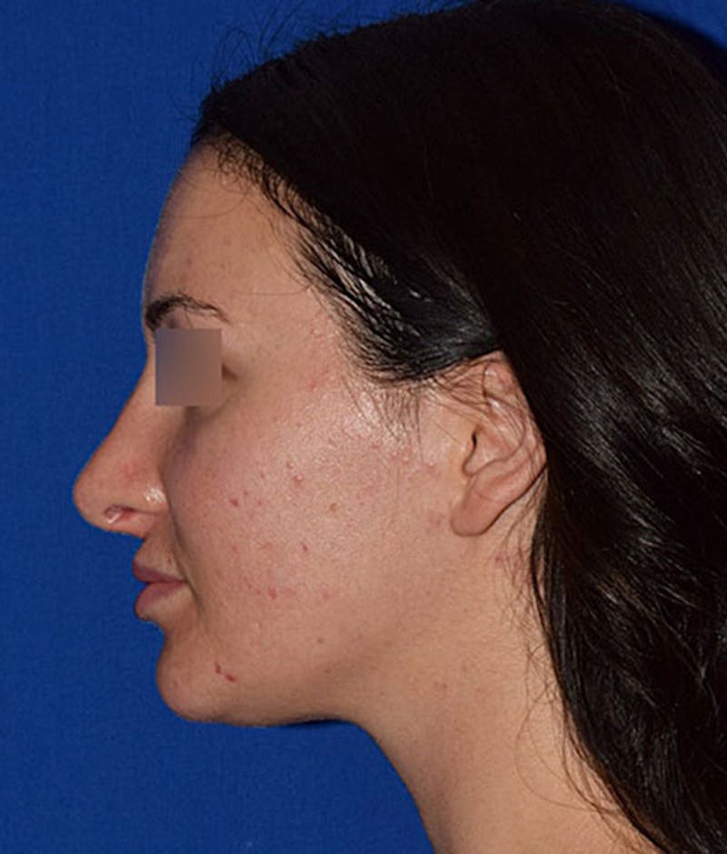 Lip Lift Before & After Gallery - Patient 386914 - Image 5