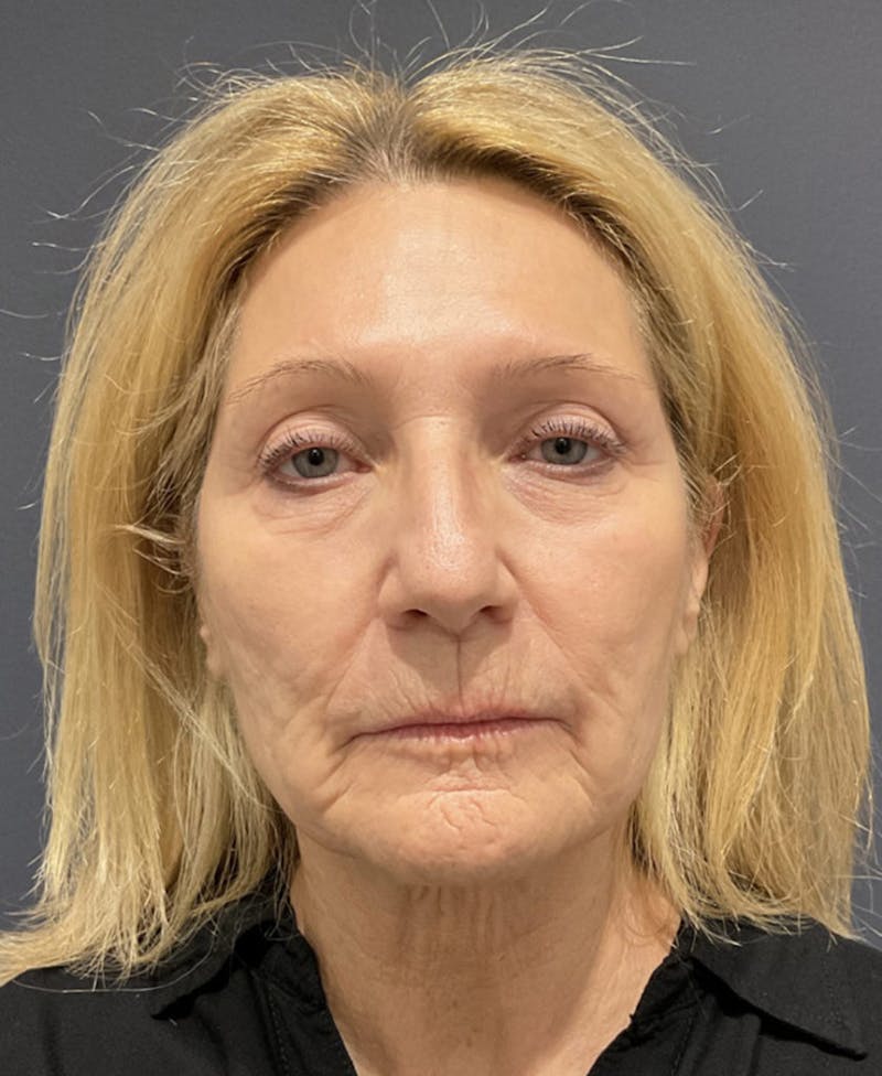 Facelift Before & After Gallery - Patient 162113 - Image 5