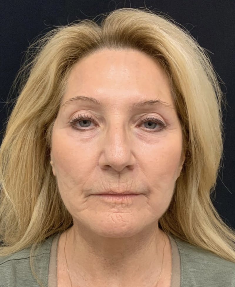 Facelift Before & After Gallery - Patient 162113 - Image 6