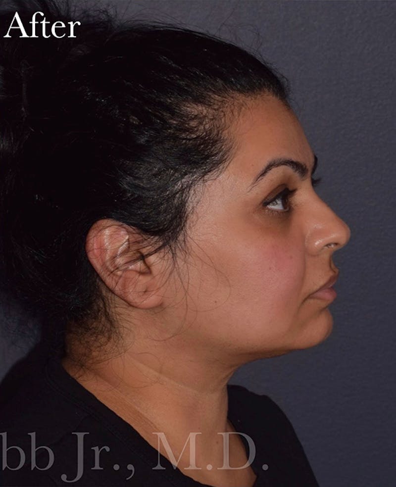 Buccal Fat Reduction Before & After Gallery - Patient 261506 - Image 4
