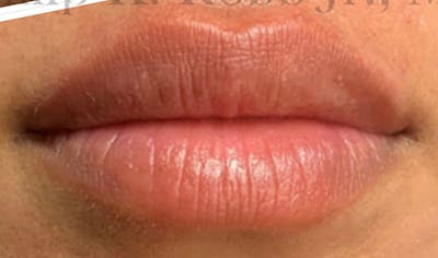Fillers Before & After Gallery - Patient 239191 - Image 2